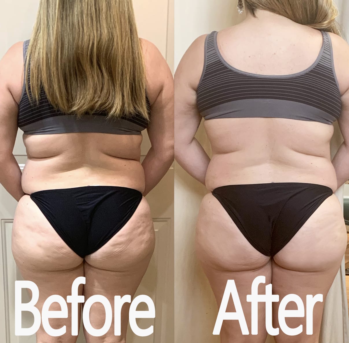 VelaShape, Vaccum Therapy, & Cellulite Treatment Before & After