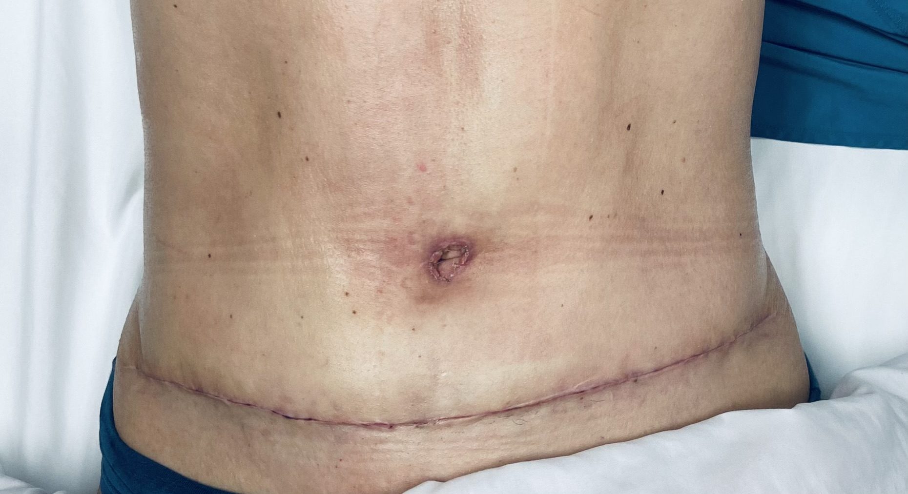 Post Op & Scar Tissue Treatment Before & After Photos