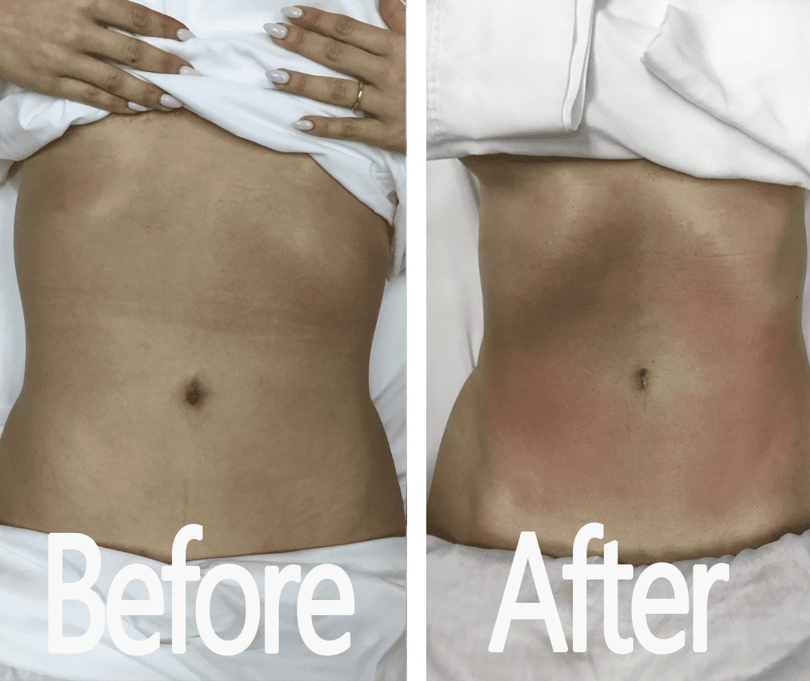 Body Slimming Massage & Treatment Before & After