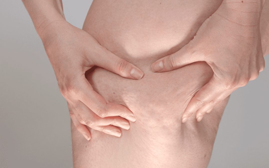 Can Body Wraps Help You Lose Weight?
