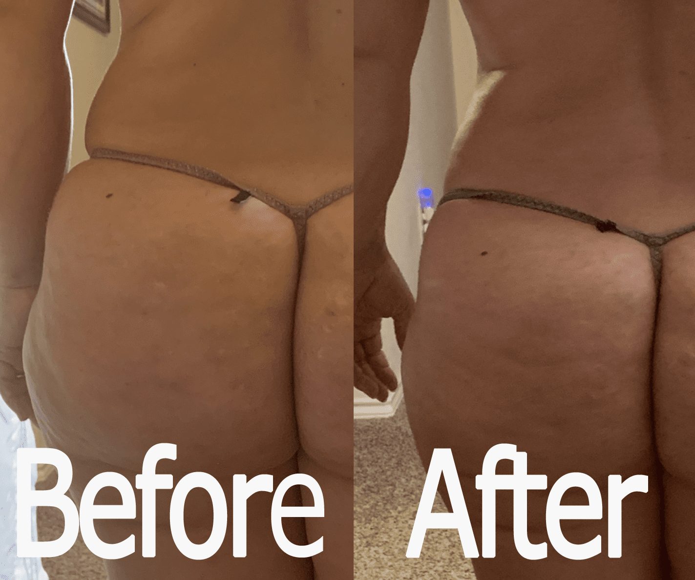 Body Slimming Massage & Treatment Before & After