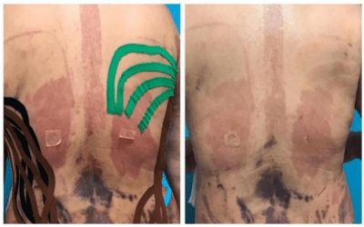 Kinesiology Tape in Post-Surgical Recovery