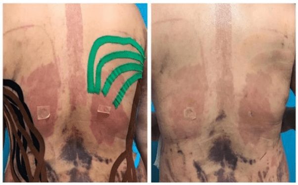 Kinesiology Tape in Post-Surgical Recovery