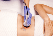 Endermologie for scar tissue