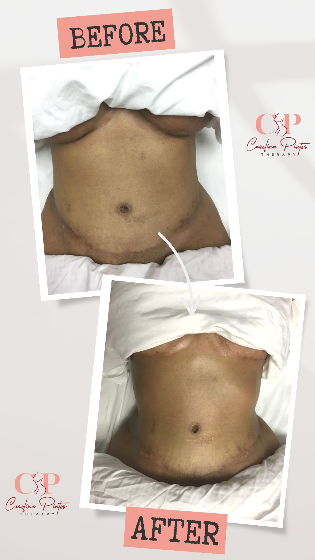 Post Op & Scar Tissue Treatment Before & After Photos