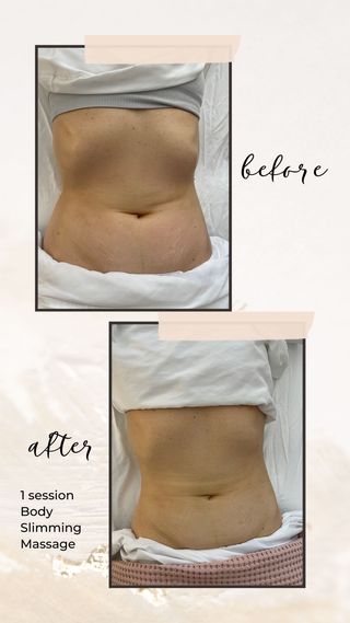 VelaShape, Vaccum Therapy, & Cellulite Treatment Before & After Photos