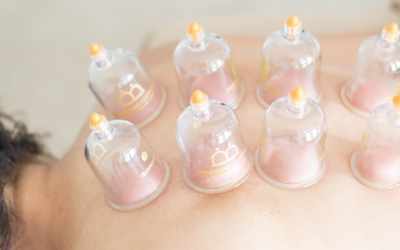 Cupping Therapy in the Treatment of Chronic Fatigue Syndrome