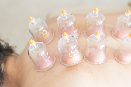 Cupping Therapy in the Treatment of Chronic Fatigue Syndrome