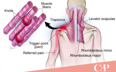 Myofascial Release and Myofascial Pain Syndrome