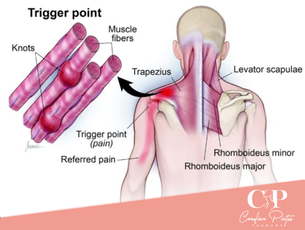 Myofascial Release and Myofascial Pain Syndrome