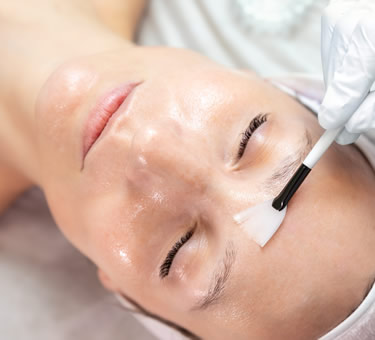 chemical-peel