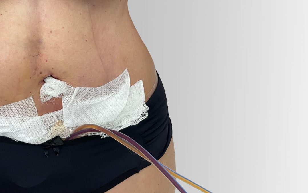 Manual Lymphatic Drainage After Surgery