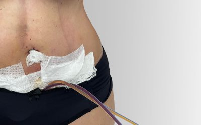 Manual Lymphatic Drainage After Surgery