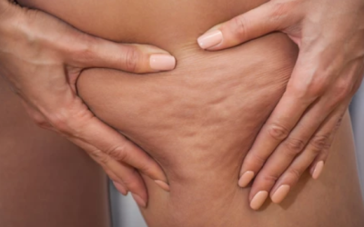 Cellulite Reduction Myths vs. Facts