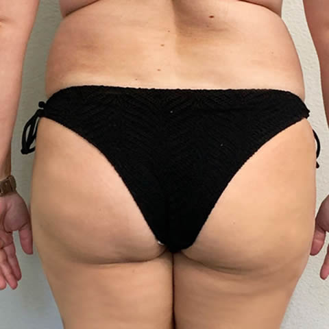 Cellulite Treatment in Houston - Carolina Pintos Therapy