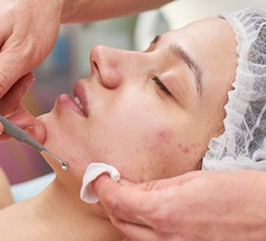 Acne Facial Treatment Esthetician performing an acne facial treatment on a client in Houston