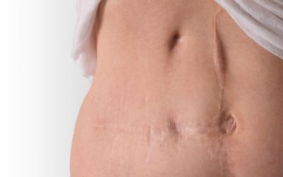 The Risks of Incisional Drainage Massages and the Importance of Safe Post-Operative Care Techniques