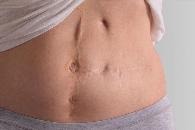 Dog Ears After a Tummy Tuck: What They Are, and What Massage Can and Cannot Do