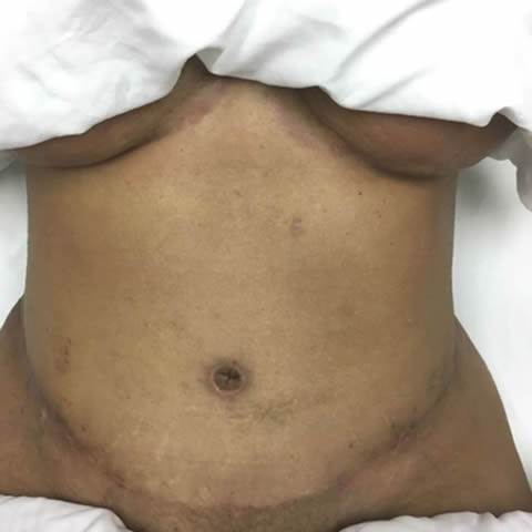 Seroma After a Tummy Tuck: How to Tell One From Normal Swelling
