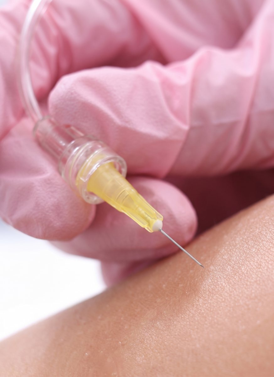 Close-up of a pink-gloved hand holding a fine carboxytherapy needle connected to clear CO2 tubing just above the skin