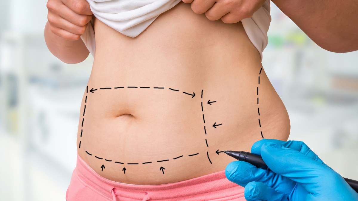 Body contouring surgery markings Houston – heat and recovery Surgeon marking a patient's abdomen before body contouring surgery, the area where sensation is reduced afterwards