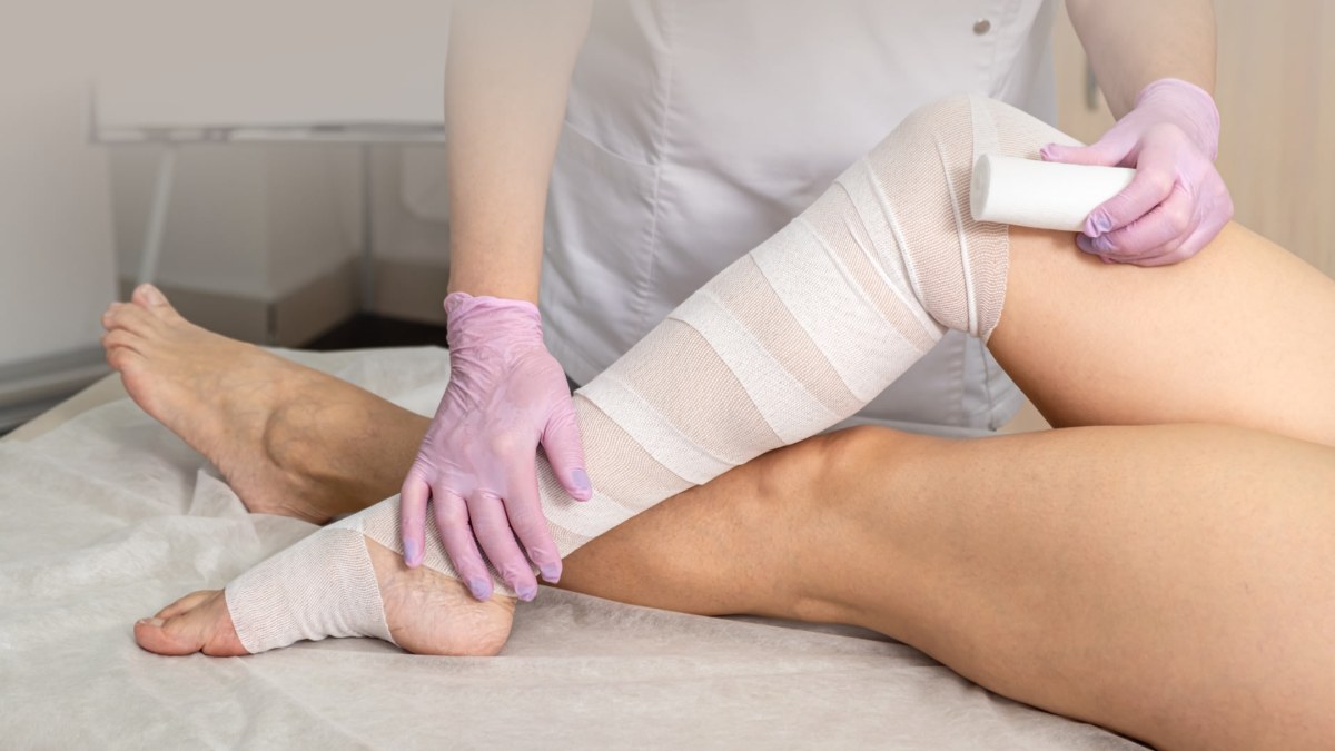 Compression bandaging for lipedema in Houston Therapist applying multilayer compression bandaging to a client's leg as part of lipedema management in Houston