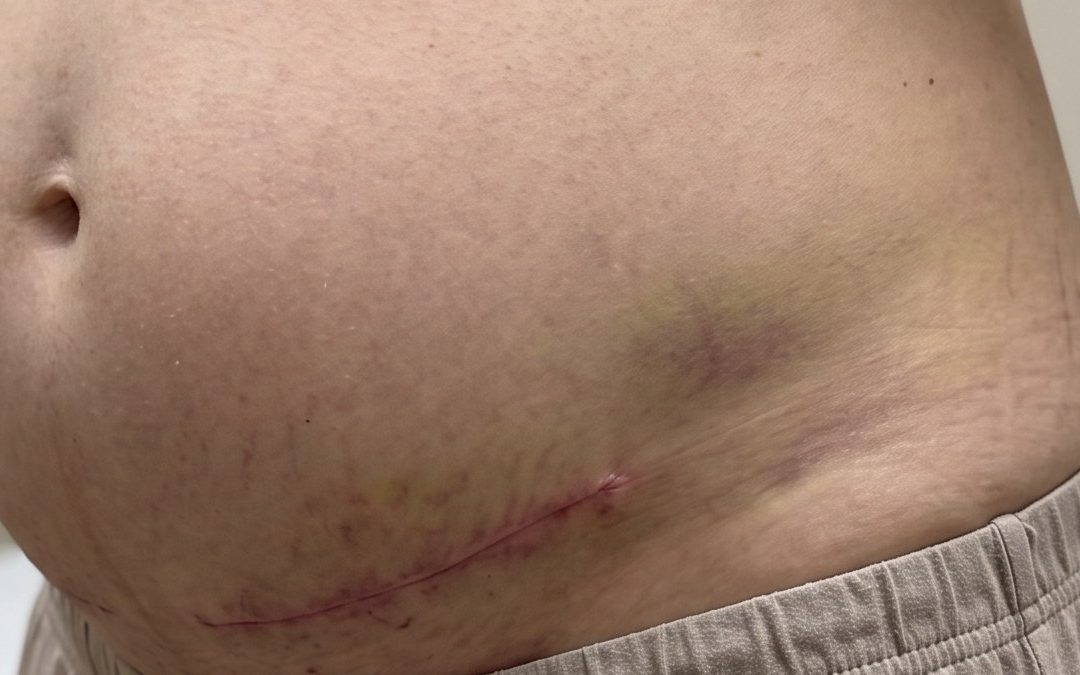 Seroma After a Tummy Tuck: How to Tell One From Normal Swelling