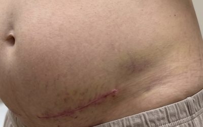 Seroma After a Tummy Tuck: How to Tell One From Normal Swelling