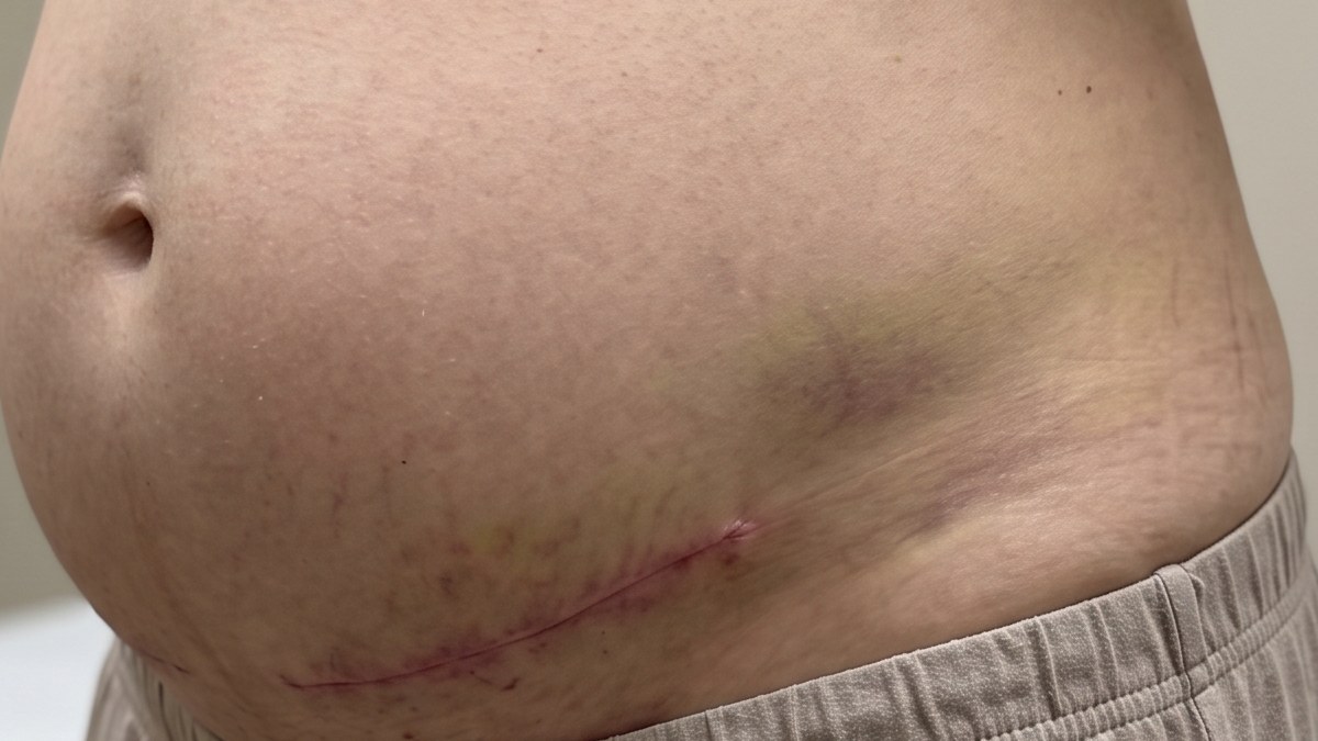 Normal swelling and bruising after a tummy tuck, early recovery Swollen, bruised abdomen in the early weeks after a tummy tuck, with a healing low incision and no drain